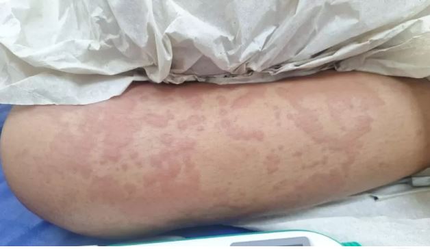 Governo do RN investiga se menina internada foi contaminada por detergente caso de bacteria em menina que usou produto da Ype